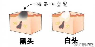 ​最有效去黑头 怎么去黑头最有效？去黑头小妙招