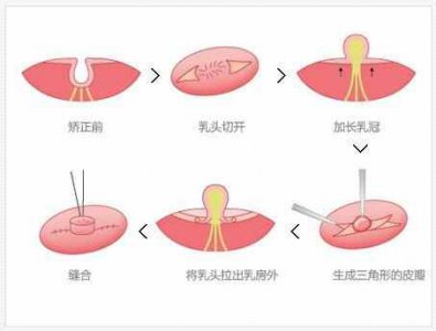 ​乳头内陷矫正术 乳头凹陷怎么办？五大方法让您治愈！